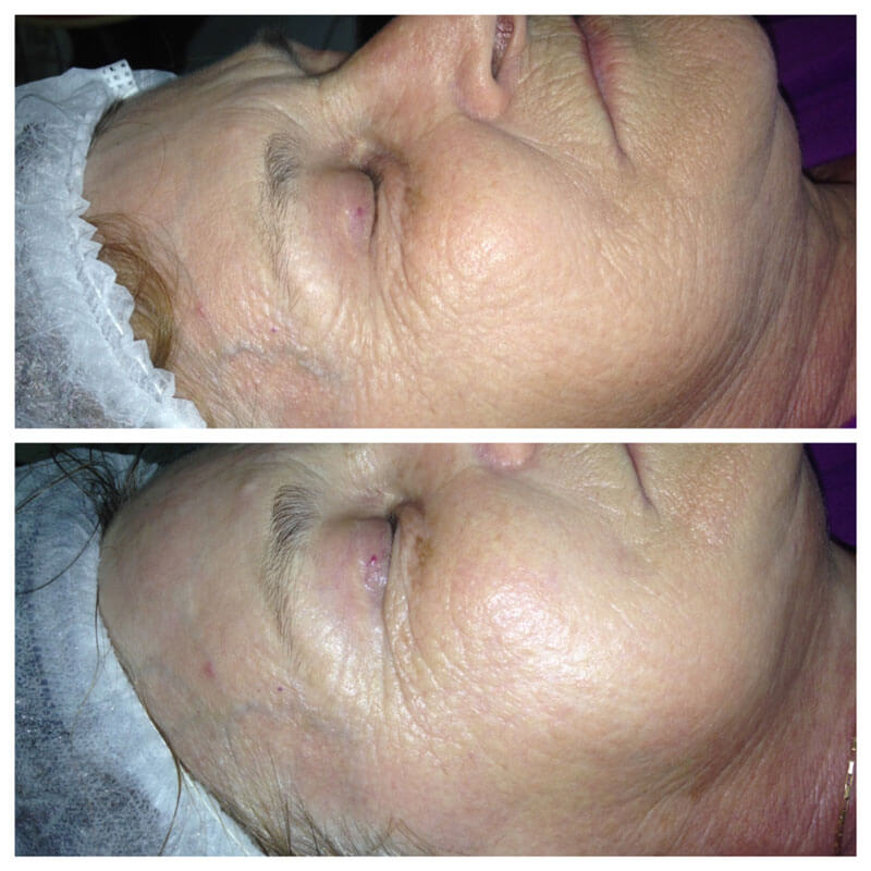 antes-e-depois-tratamento-laser-2