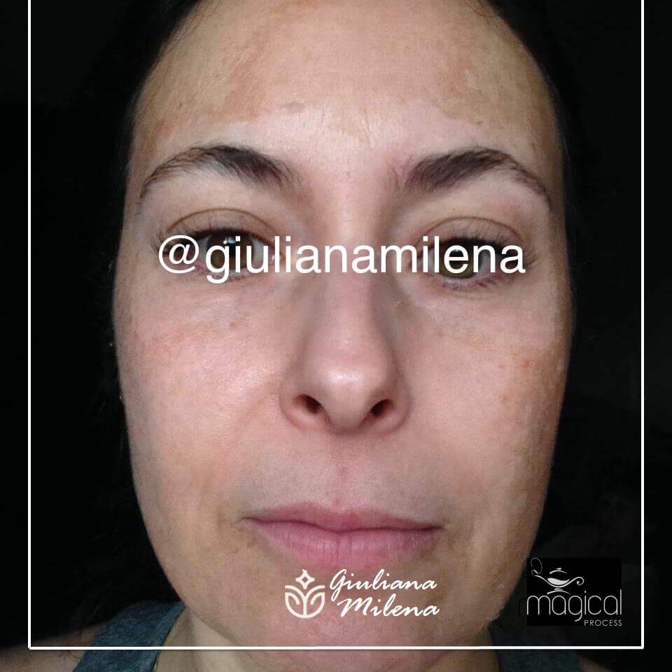 Meu tratamento contra o melasma